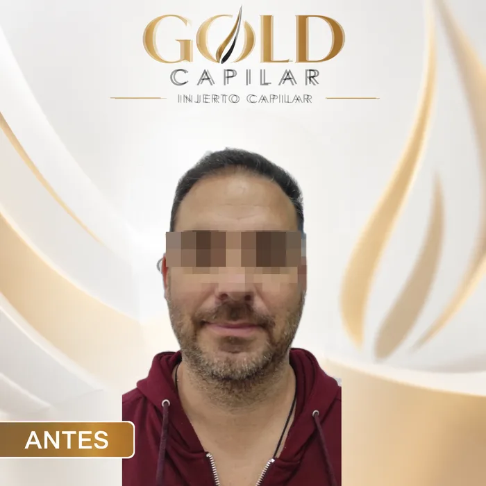 Paciente antes del injerto capilar