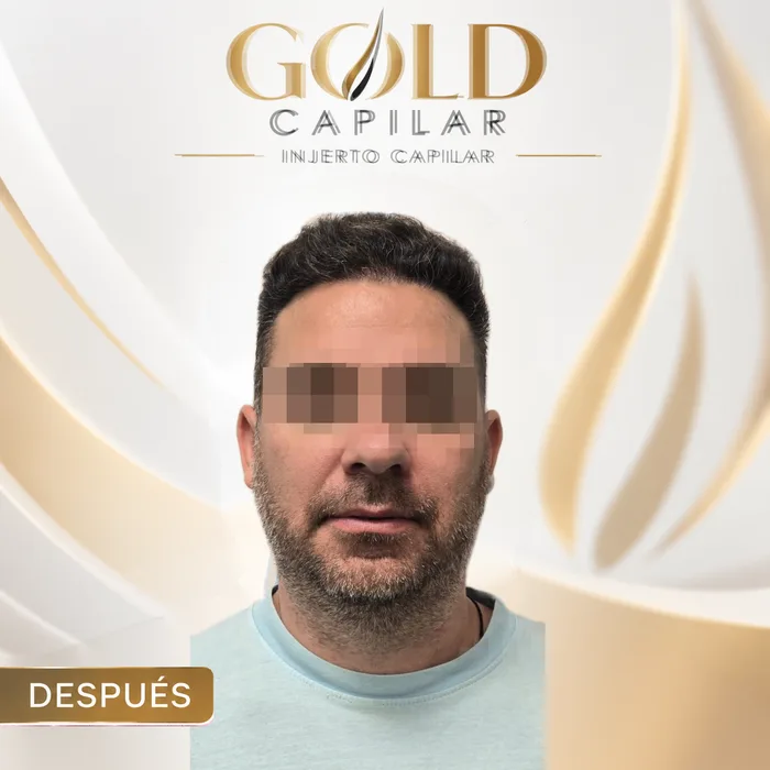 Paciente después del injerto capilar