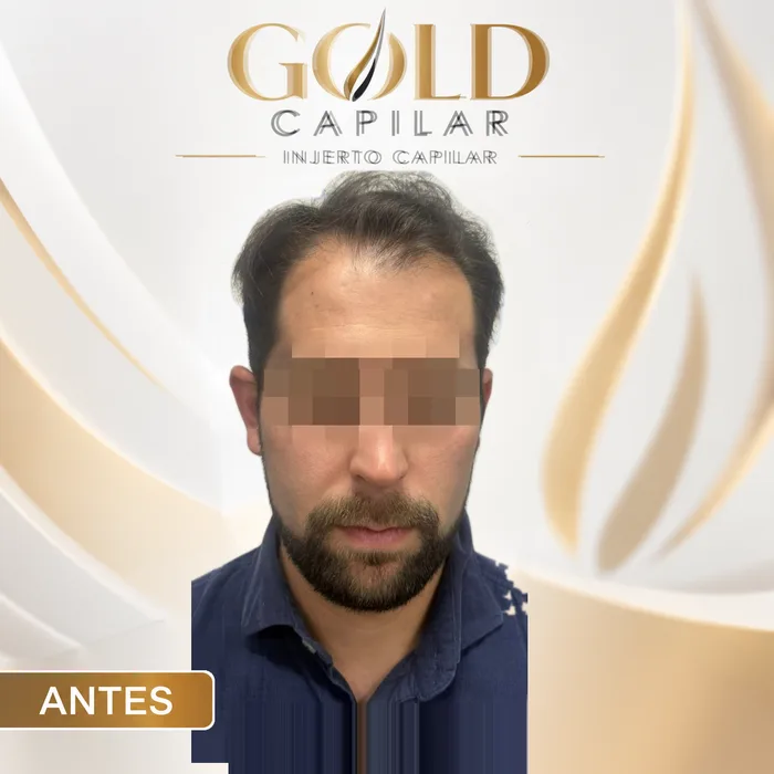 Paciente antes del injerto capilar