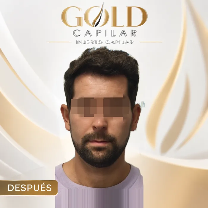 Paciente después del injerto capilar