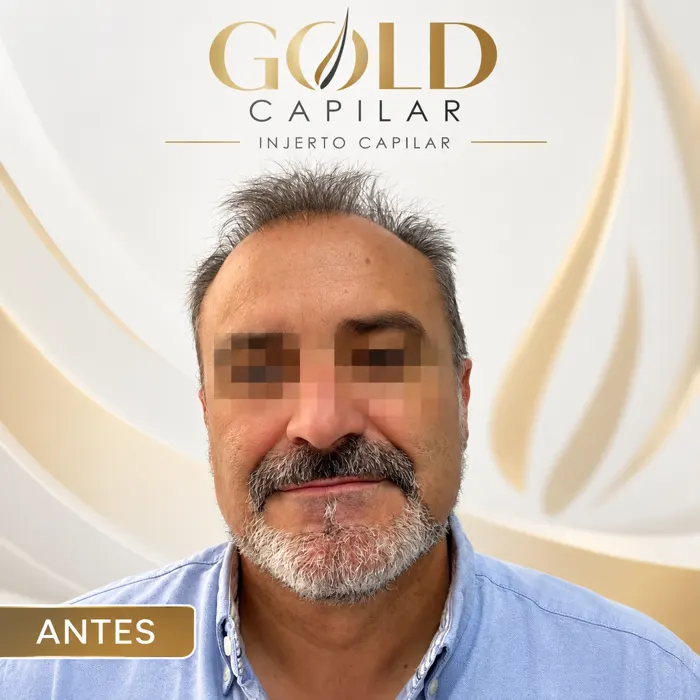 Paciente Juan antes del injerto capilar